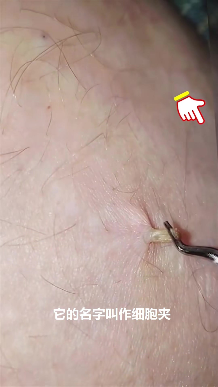 最新擠膿包視頻,見證變化的力量,自信與成就感的誕生之地