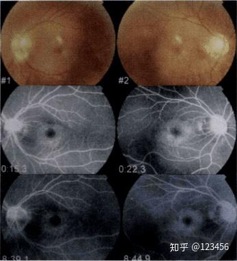 最新藥肺炎詳解，你需要知道的一切——健康小紅書